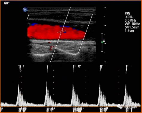 颈部血管超声检查及诊断标准颈总动脉颈动脉颈部血管超声血流斑块管径 健康界