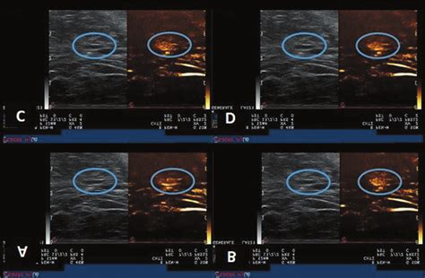 Axillary node enhanced in contrast-enhanced ultrasound (blue circle) at... | Download Scientific ...