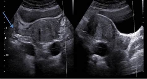 Sagittal Uterus Ultrasound