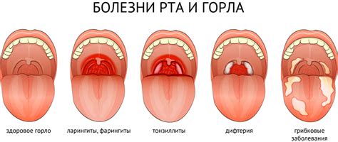 Строение горла, гортани и глотки человека: клиническая анатомия ...