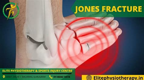 Jones Fracture