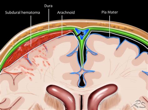 Subdural Vs Epidural Hematoma Bheinnfarhana