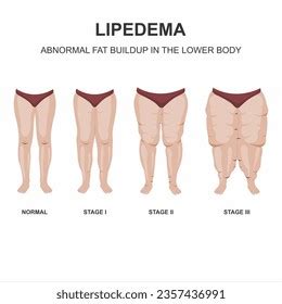 42 Lipedema Stages Images, Stock Photos, 3D objects, & Vectors ...