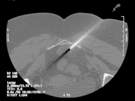 Ct Guided Biopsy Through Presacral Lesion Using Posterolateral Approach Download Scientific