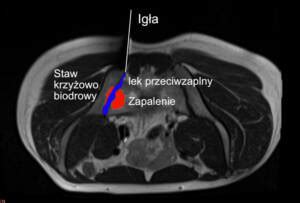 Blokada stawu krzyżowo biodrowego pod kontrolą rezonansu magnetycznego