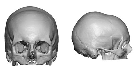 Plastic Surgery Case Study - Custom Skull Implant Correction of a Coronal Skull Depression ...