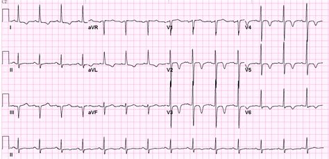 EKG abnormalities in central nervous system disease - wikidoc