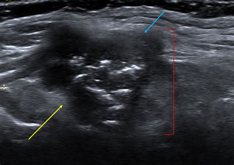 Thyroid Anatomy And Ultrasound Evaluation Techniques In Vascular