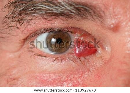 Close Up Of Human Eye With Hematoma Stock Photo 110927678 : Shutterstock