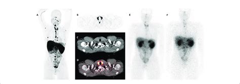 Thyroid Uptake Patterns In The Patient Before And After 177