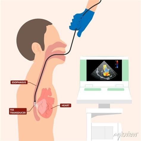 Cath Lab Atrial Septal Defect Tetralogy Of Fallot Patent Foramen