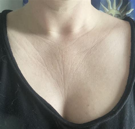 Chest Wrinkles Is There Any Hope 33f Currently I Dont Have A