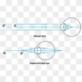 Image Myopic Eye And Hypermetropic Eye - Ray Diagram For Myopia, HD Png ...