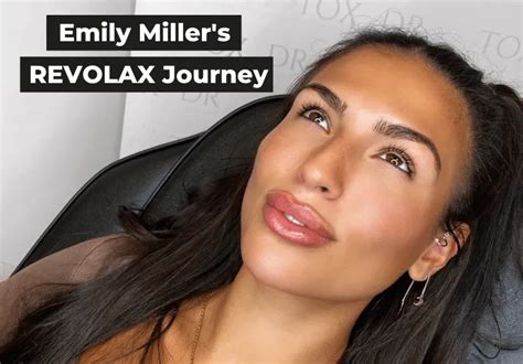 Emily Millers Lip Filler Journey Blog Revolax Uk