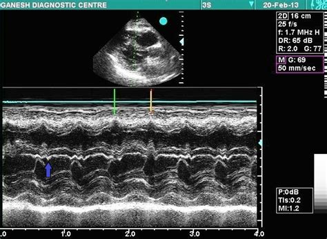 Echocardiography In The Presence Of Left Bundle Branch Block Cardioserv