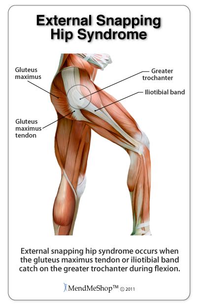 Hip Flexor Strain-Tear