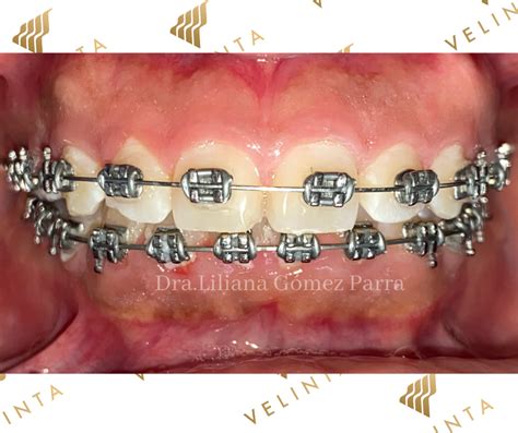 Brackets Met Licos Cl Nica Velinta