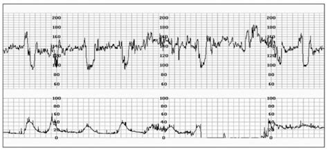 Fetal Heart Rate Monitoring Principles And Intepretation Of Cardiotocography Virtual Library