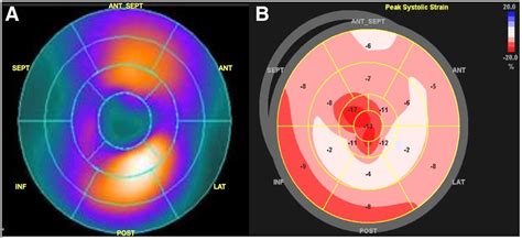 Global And Regional Variations In Transthyretin Cardiac Amyloidosis A