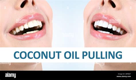 Coconut Oil Pulling For Teeth Whitening Demonstration Of Result Before And After Procedure