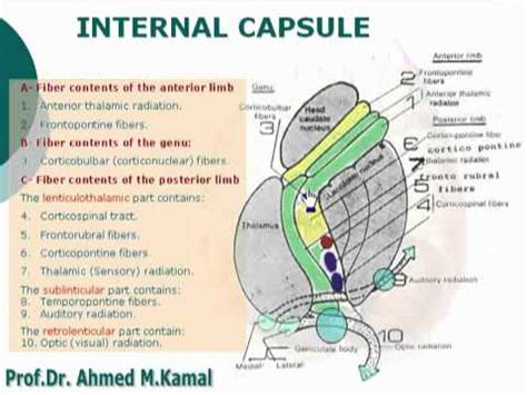 Infarction: Internal Capsule Infarct