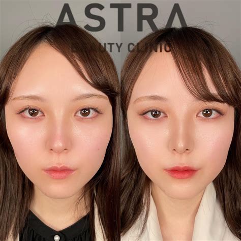 鼻尖形成・軟骨移植 【公式】astra Beauty Clinic（アストラビューティクリニック）｜美容外科・美容皮膚科・形成外科｜渋谷駅前