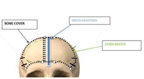 Schematic View Of A Bifrontal Modified “in Window” Technique For Download Scientific Diagram