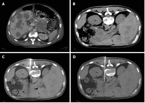 Percutaneous Computed Tomography Guided Core Needle Biopsy Of A Download Scientific Diagram