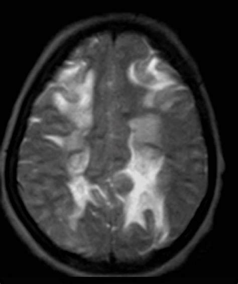 MRI of head showing axial T2WI subcortical and deep white matter T2 ...