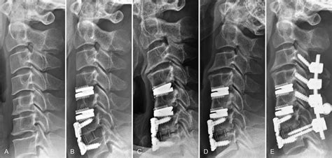 Late Complication Of Cervical Disc Arthroplasty Heterotopic Ossification Causing Myelopathy