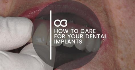 How To Care For Your Dental Implants Oasis Dental Studio