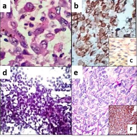 Epithelioid sarcoma (a) Histopathology showed tumour cells with... | Download Scientific Diagram