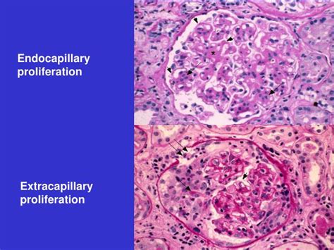 Ppt Glomerular Diseases Powerpoint Presentation Id