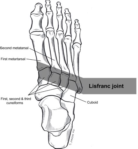 Lisfranc Injury A Injury To The Midfoot Sydney Physio Clinic