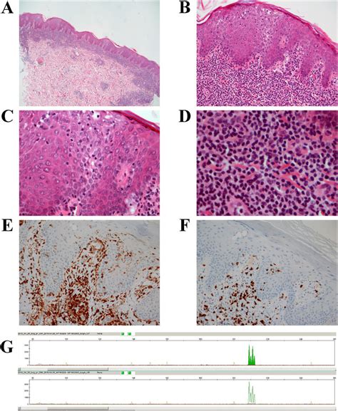 The Histomorphological Features Of The Skin Lymphoma A Hande Section