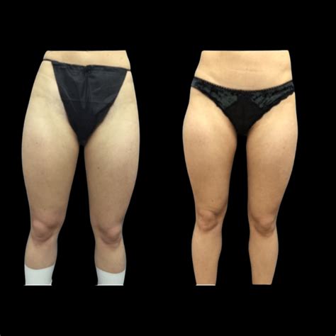 Inner Thigh Lipo Before And After Hot Sex Picture