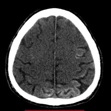 Subarachnoid Haemorrhage Radiology Reference Article Radiopaedia Org