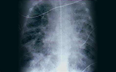 Lung Protective Ventilation to Prevent BPD - CHOP OPEN