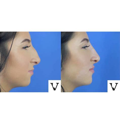 Asymmetrical Face Correction Makes Your Beautiful Jawline Visage