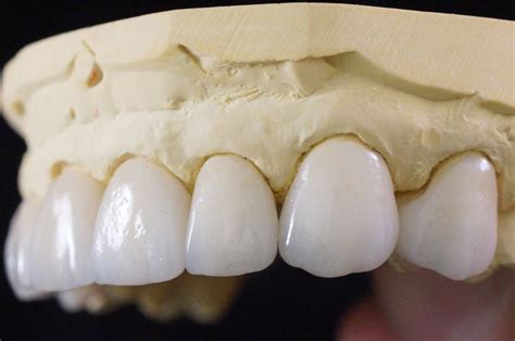 IPS E Max Porcelain Crowns And Veneers