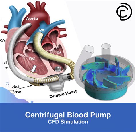 Centrifugal Blood Pump Cfd Simulation Ansys Fluent Training