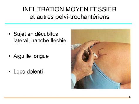 PPT Pathologie péri articulaire membre inférieur PowerPoint