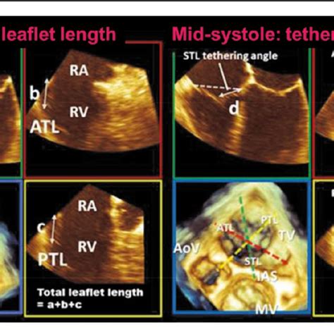 Assessment of tricuspid annulus using 3-D transesophageal... | Download ...