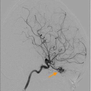 Right Internal Carotid Artery Angiogram Lateral View Showing The