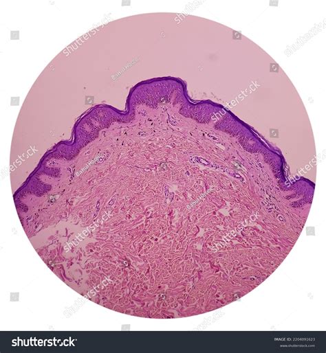 Skin Tissue Biopsy Lichen Planus Show Stock Photo 2204091623 | Shutterstock