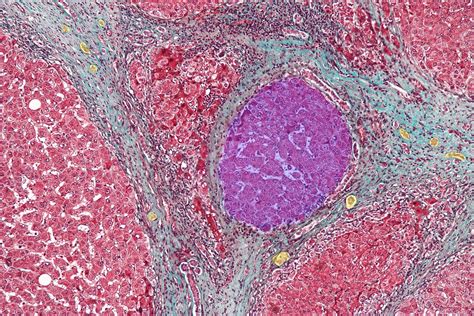 Alcoholic Liver Cirrhosis Histology