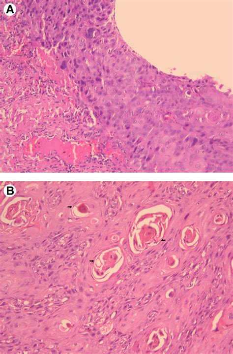 Primary Intraosseous Squamous Cell Carcinoma Arising In Odontogenic