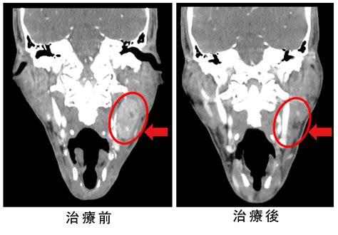 突然變聲、喉嚨痛別輕忽！頸部發現小腫塊 當心癌症上身 生活 Nownews今日新聞