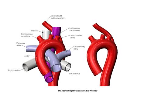 Stl File Aberrant Right Subclavian Artery Anomaly 3d Print Model