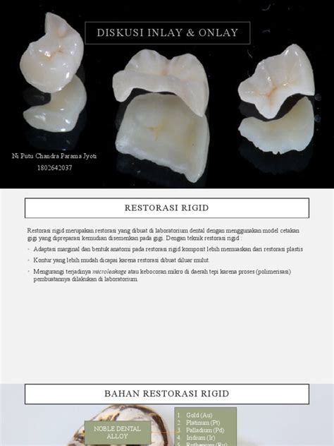 inlay onlay  teknologi rekayasa